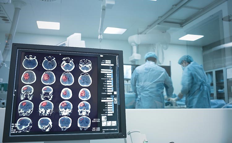 avc hemorragico quando a cirurgia e necessaria