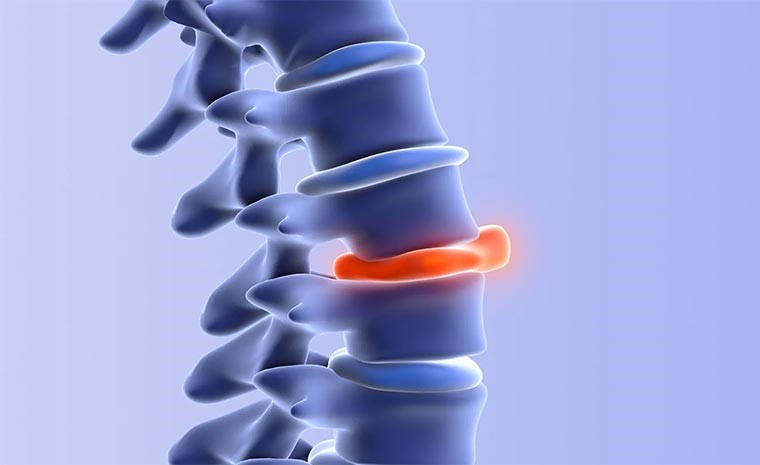 denervacao facetaria ajuda em hernia de disco entenda a relacao