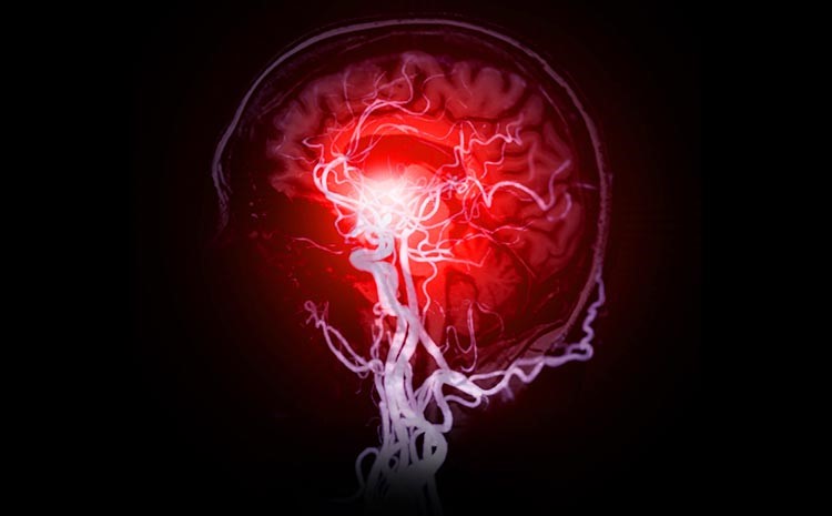 nem todo aneurisma precisa ser operado a arte da decisao na neurocirurgia vascular