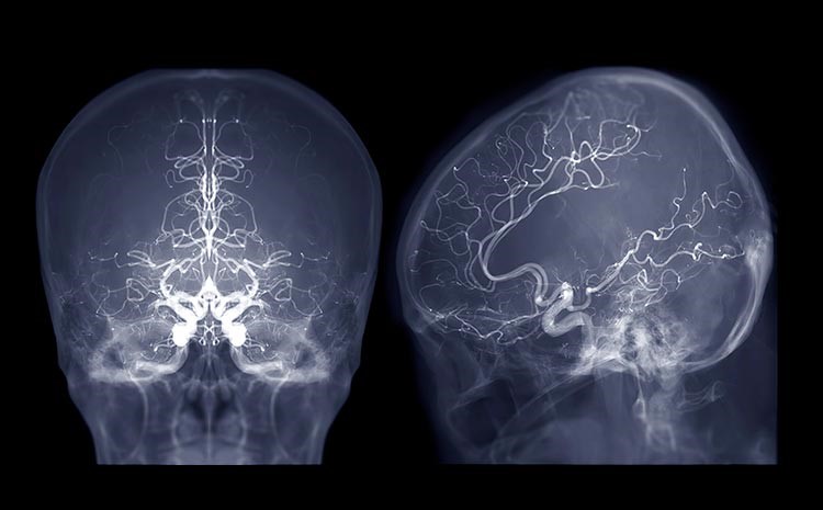 neurocirurgia vascular quando e indicada no avc e aneurisma