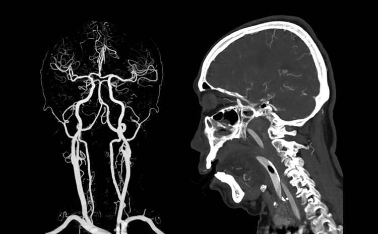 o cerebro em camera lenta como a lente da angiografia revela segredos ocultos