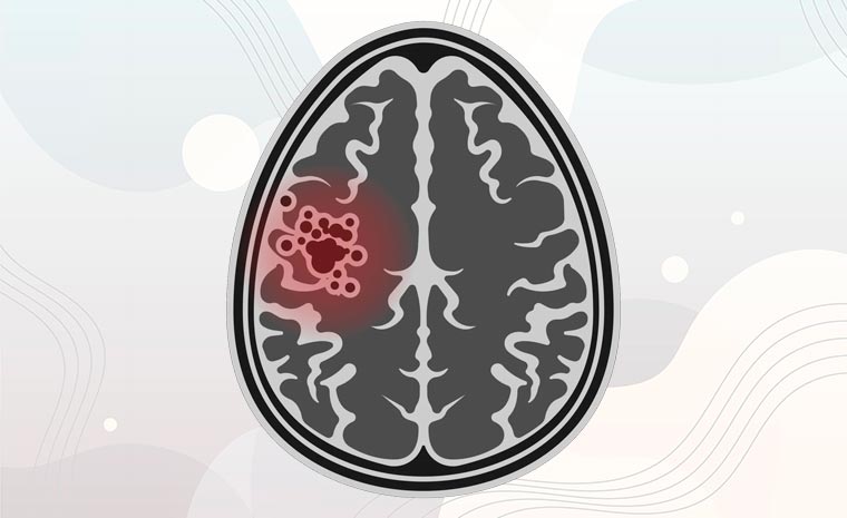 o que sao cavernomas e como sao diagnosticados