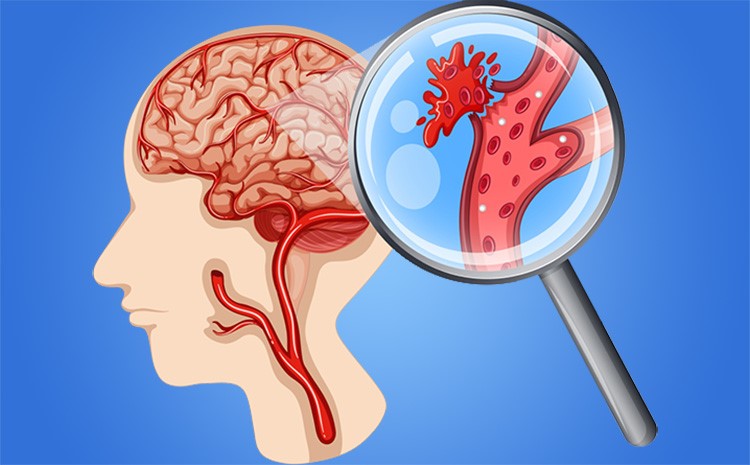 por que alguns vasos do cerebro se rompem e outros nao