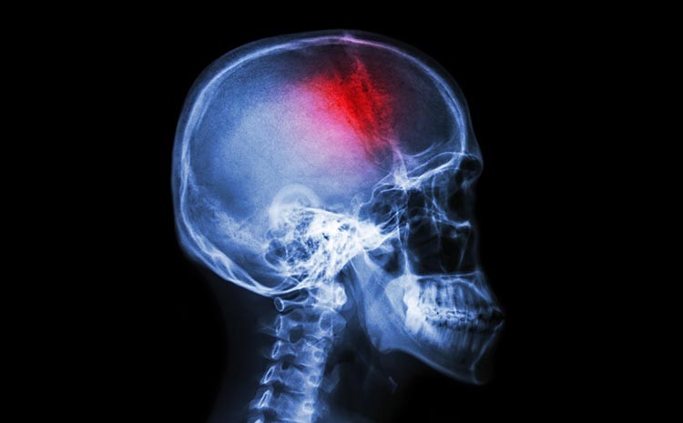 quando o tempo decide o que esta em jogo nas primeiras horas de um avc